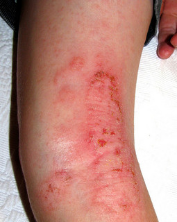 eczema on the kness