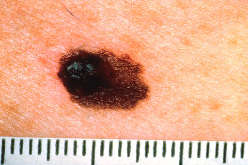 asymmetrical melanoma