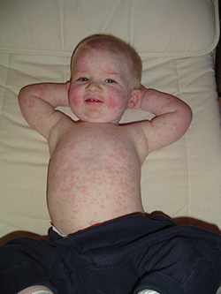 child with Fifth disease (slapped cheek disease)