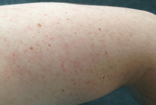 Keratosis pilaris on upper outer left arm of a male.