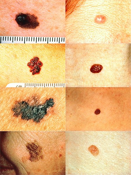 Melanoma ABCD criteria