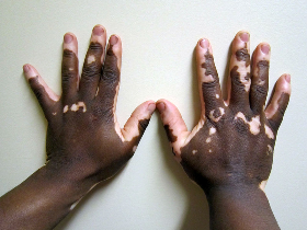 vitiligo on hands of dark skinned person