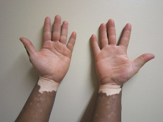 Vitiligo hands