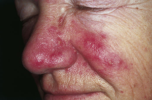 Man with Rosacea on Cheeks and Nose