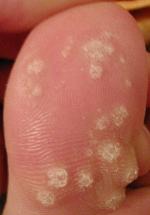 Common Warts on Big Toe